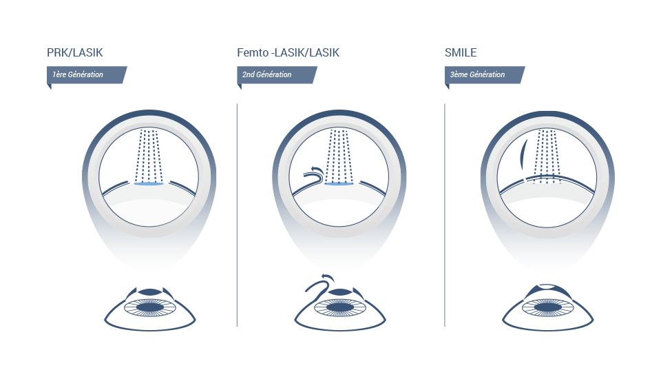 PKR -  LASIK - SMILE